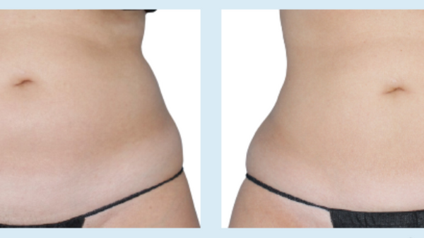 Coolsculpting Package