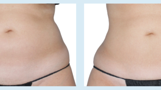 Coolsculpting Package