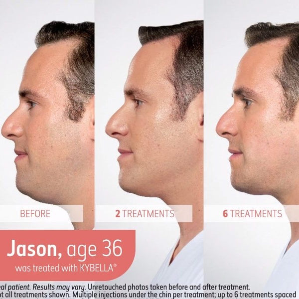 Kybella® Double Chin Treatment